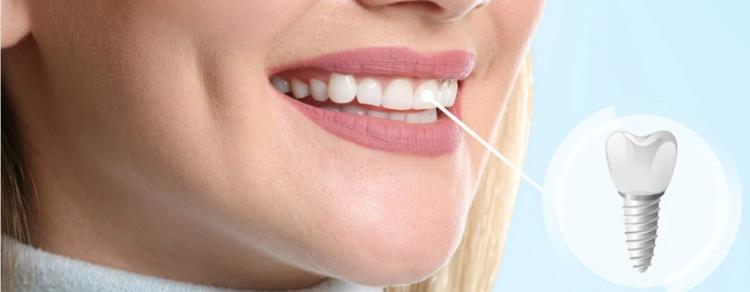 زراعة الأسنان